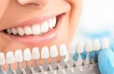 Виниры в стоматологии: эстетика и функциональность